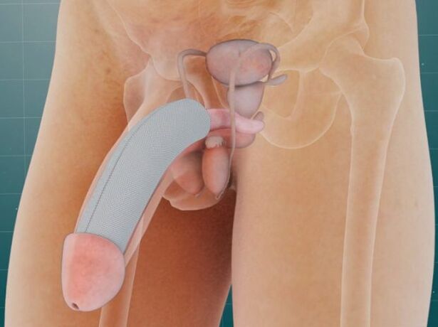 Penis nakon uvođenja posebnog implantata ispod kože