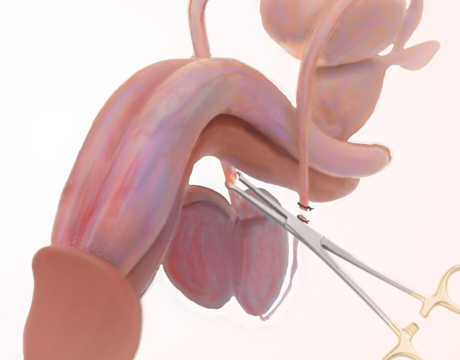 ligamentotomija za povećanje penisa